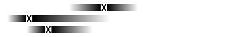 Diagram Hjärntumör hos barn