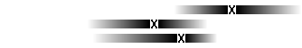 Diagram Hjärntumör hos vuxna
